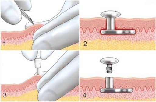 Aplikace microdermalu